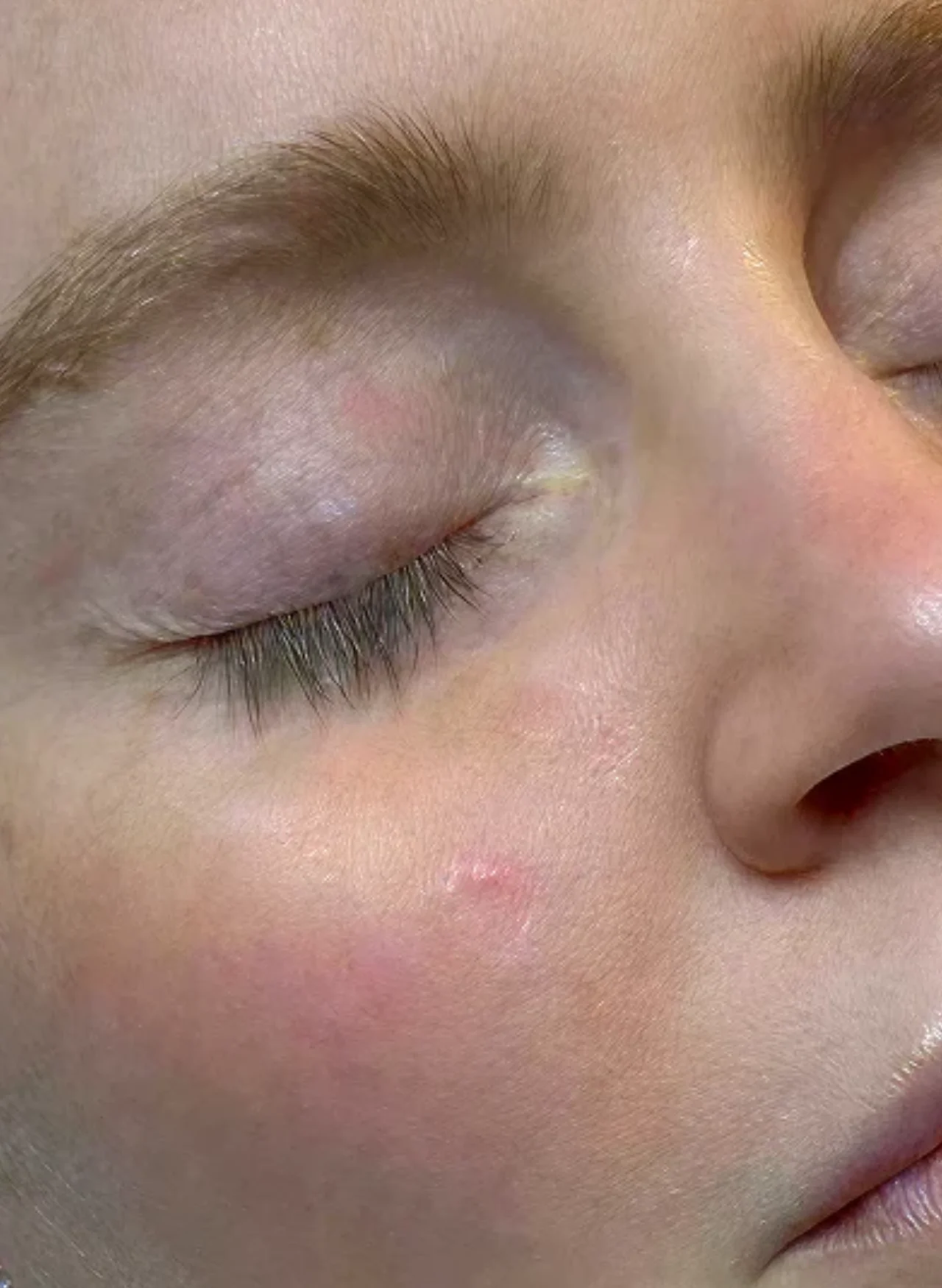 Before Treatment