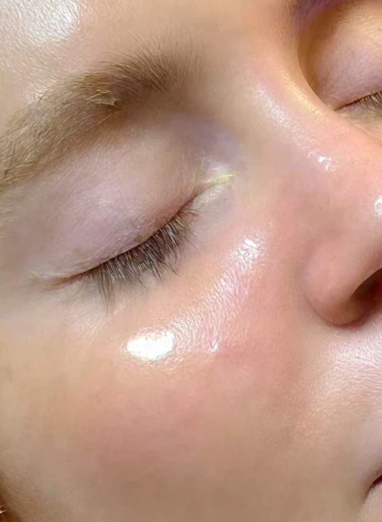After Treatment