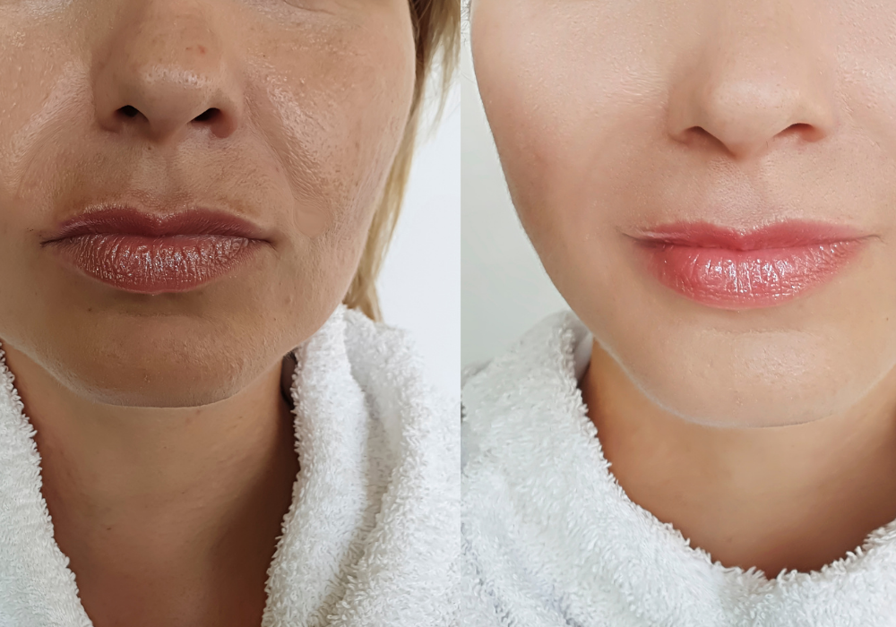 Dermal Fillers
