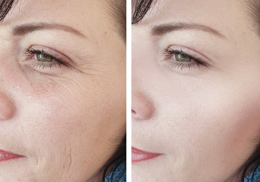 Anti-Wrinkle Injections