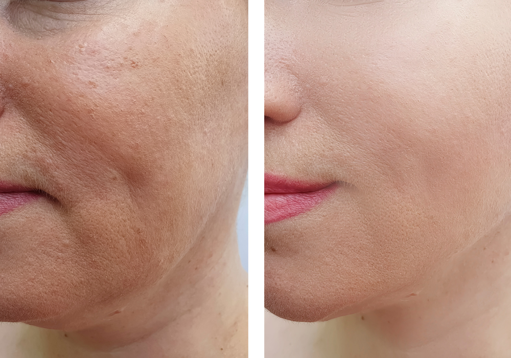 Skin Boosters